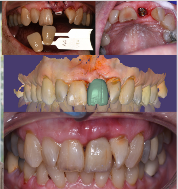 BioSeal implant restoration case showing preoperative shade records, implant site, digital design, and final clinical result