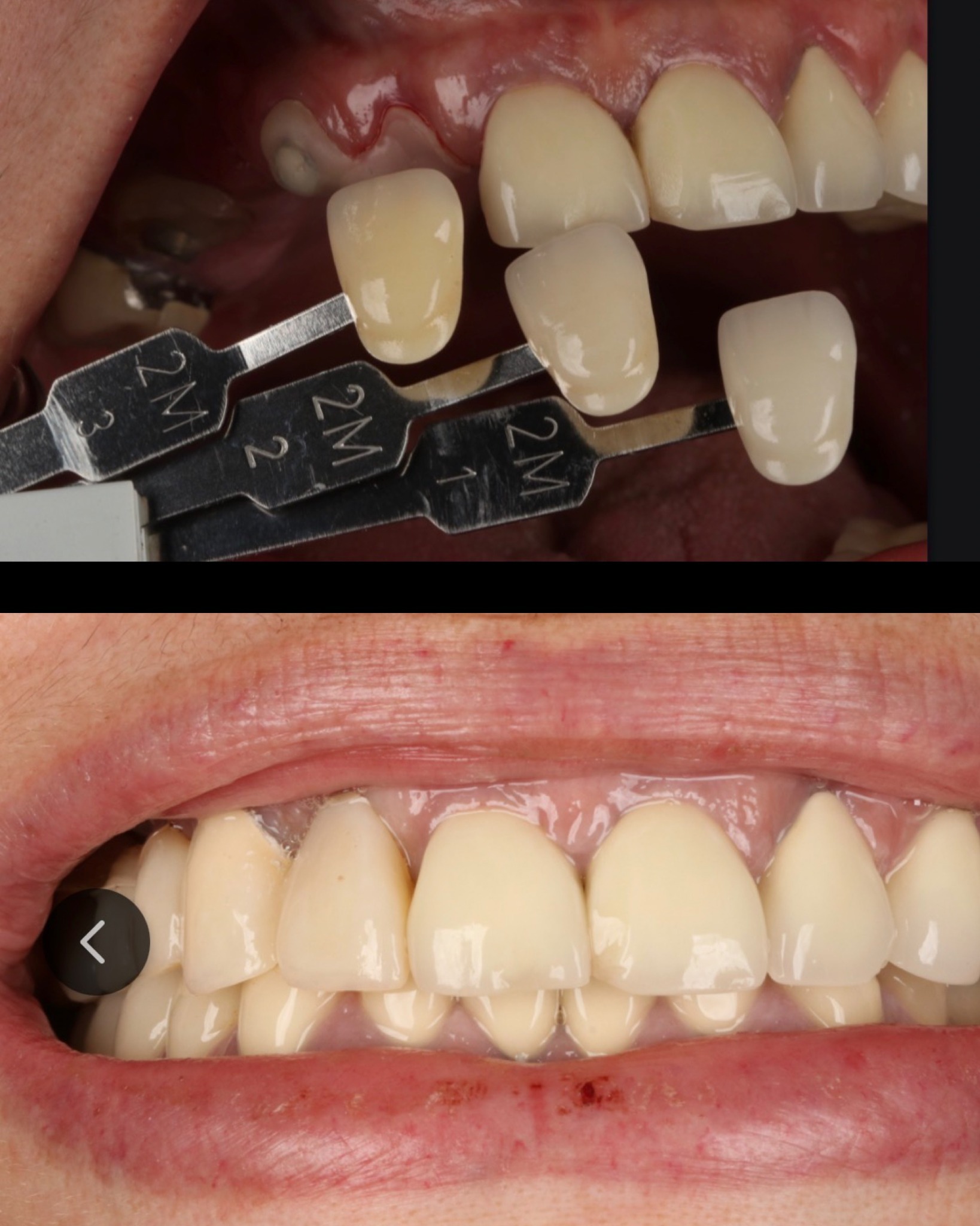 Clinical shade photograph showing three shade tabs beside adjacent teeth